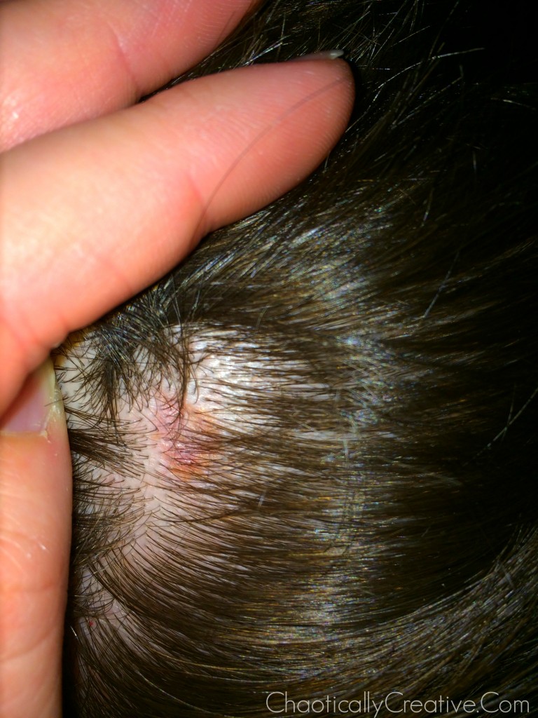 What Does Skin Cancer On Scalp Look Like